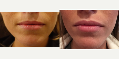 Lip Fillers before and after photo