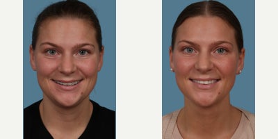 PrecisionTx before and after photo