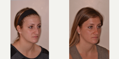 Rhinoplasty before and after photo