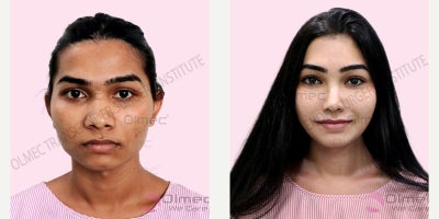 Adam's Apple Reduction before and after photo