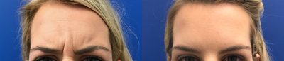 Botox before and after photo
