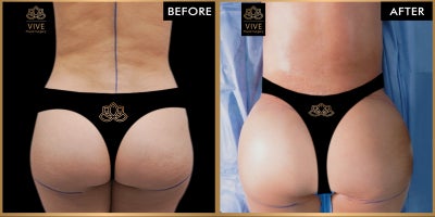 Brazilian Butt Lift before and after photo