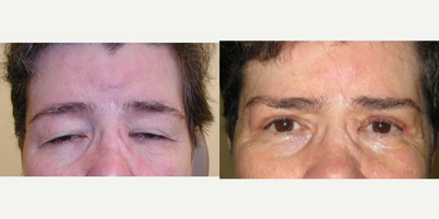 Brow Lift before and after photo