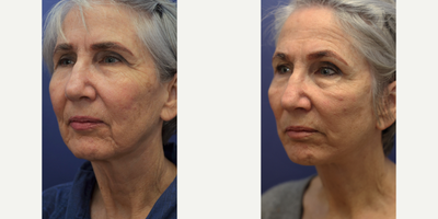 Facelift before and after photo