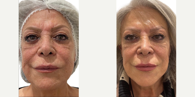 Lip Fillers before and after photo