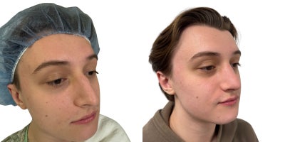 Rhinoplasty before and after photo