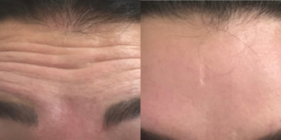 Botox before and after photo