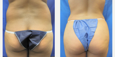 Brazilian Butt Lift before and after photo