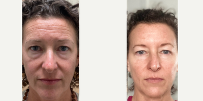 Cheek Fillers before and after photo