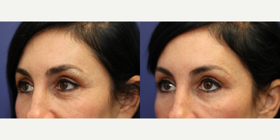 Eyelid Surgery before and after photo