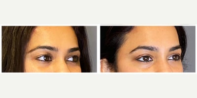 Eyelid Surgery before and after photo