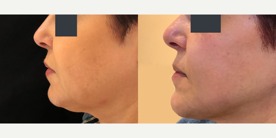 Facelift before and after photo