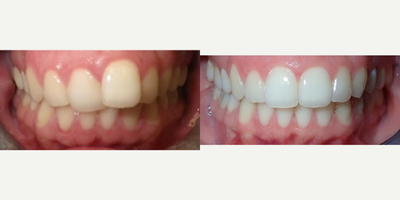 Invisalign before and after photo