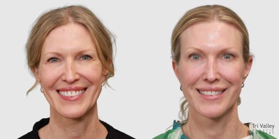 Laser Resurfacing before and after photo
