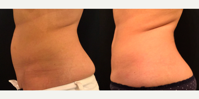 SculpSure before and after photo