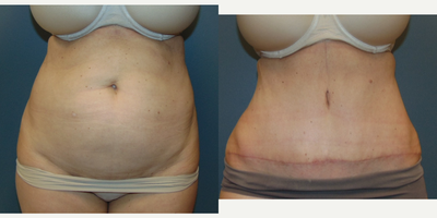Tummy Tuck before and after photo