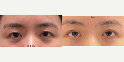 Dermal Fillers before and after photo