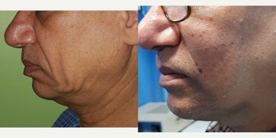 Facial Fat Transfer before and after photo