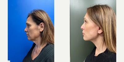 Neck Lift before and after photo