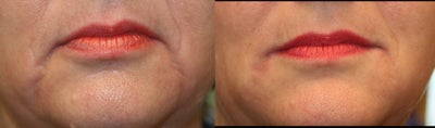 Restylane before and after photo
