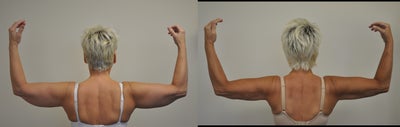 Smart Lipo before and after photo