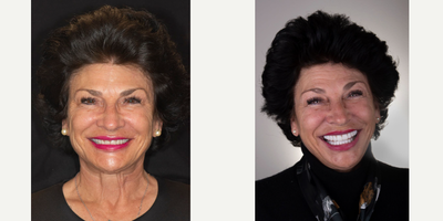 Porcelain Veneers before and after photo
