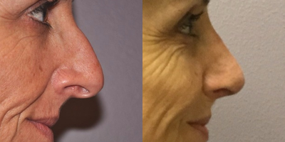 Rhinoplasty before and after photo