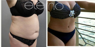 Tummy Tuck before and after photo