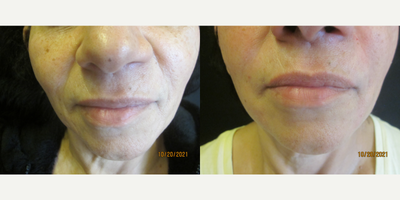Belotero before and after photo