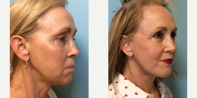 Facelift before and after photo