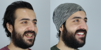 Smile Makeover before and after photo