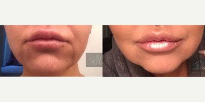 Belotero before and after photo