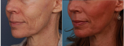 CO2 Laser before and after photo