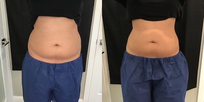 CoolSculpting before and after photo