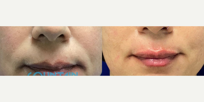 Dermal Fillers before and after photo