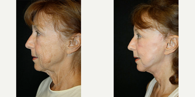 Eyelid Surgery before and after photo