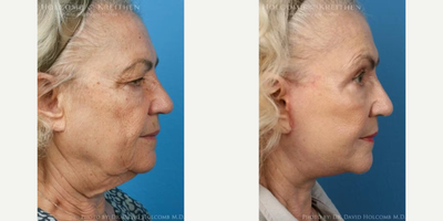 Facelift before and after photo