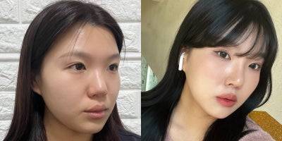 Facial Fat Transfer before and after photo
