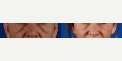 Juvederm before and after photo