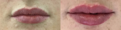Lip Fillers before and after photo
