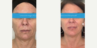 Morpheus8 before and after photo