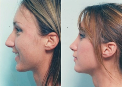 Rhinoplasty before and after photo