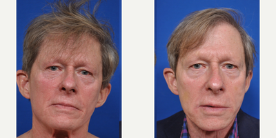 Thread Lift before and after photo