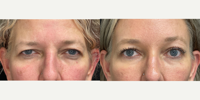 Brow Lift before and after photo