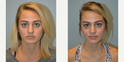 Rhinoplasty before and after photo