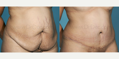 Tummy Tuck before and after photo