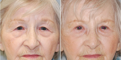 Eyelid Surgery before and after photo