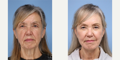 Chemical Peel before and after photo