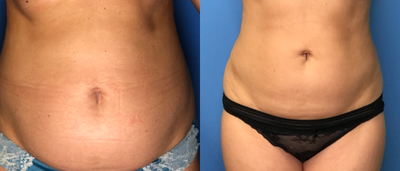 Liposuction before and after photo