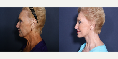 Neck Lift before and after photo